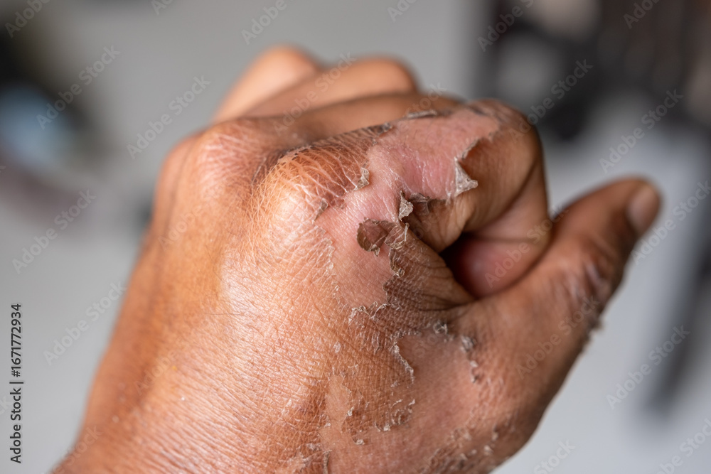 Naklejka premium Close up of human hand with peeling skin from burn injury, showing healing process, medical condition, dermatology care, and recovery concept.
