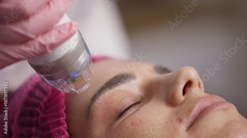 A close-up of the microneedle RF lifting procedure in a beauty salon. A young woman enjoys high-quality facial treatment, highlighting the significance of professional cosmetic procedures.