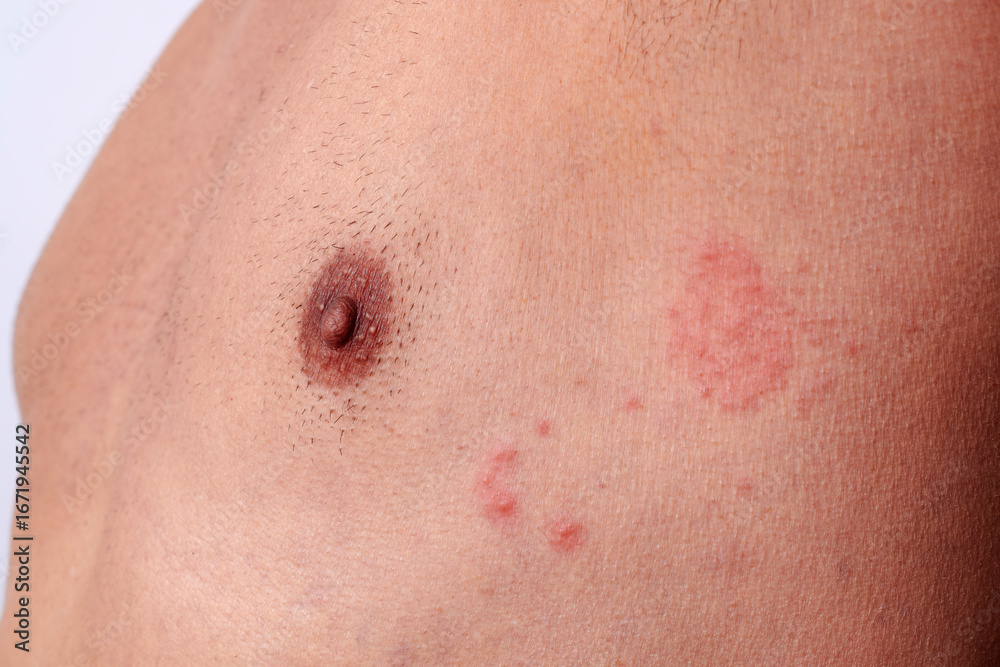 Fototapeta premium close-up of shingles on the chest of a man
