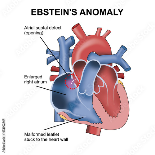Ebstein's Anomaly Flashcard Heart Illustration