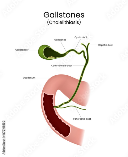 Gallstones Anatomy of Cholelithiasis and Biliary System