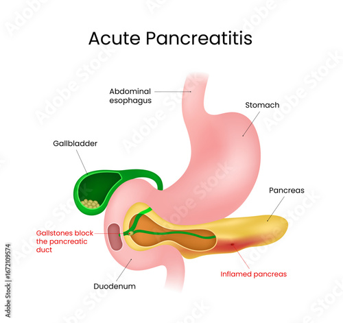 Acute Pancreatitis Anatomical Medical Illustration 