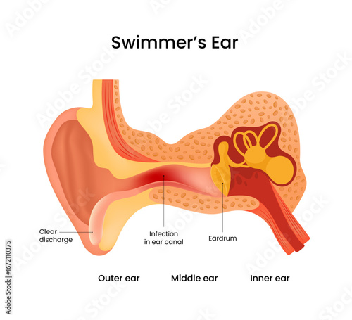 Swimmer's Ear Anatomical illustration of ear and infection