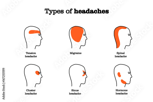 Headache location by type. Simple infographic. Vector illustration health concept.