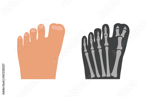Foot polydactyly of great toe. Medical chart of genetic anomaly external view and x-ray picture of the foot bones.