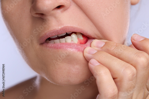Εκτύπωση καμβά Woman showing inflamed gum on light background, closeup