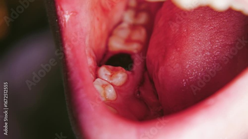 Close-up of an open mouth with a blood clot at the site of the extracted tooth. Dental cavity with a blood layer after surgery