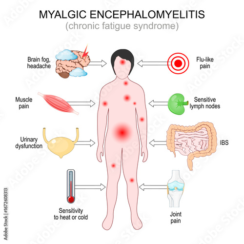 Symptoms of Myalgic Encephalomyelitis. Chronic Fatigue Syndrome