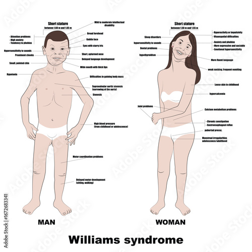 Williams syndrome is a rare genetic disorder that causes distinctive facial features, heart problems, and a very sociable personality.