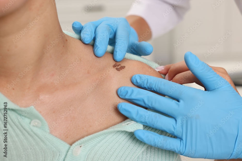 Fototapeta premium Doctor examining young woman's mole in hospital, closeup