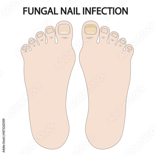 Vector illustration of fungal nail infection showing thickened, discolored, brittle nails, crumbling edges, odor, and related conditions like psoriasis, trauma, and bacterial nail disorders icon