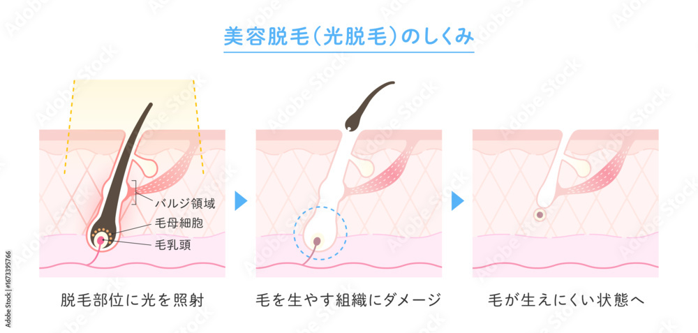 Obraz premium 美容脱毛・光脱毛のイラスト