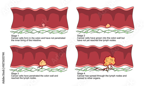 Illustration of colorectal cancer stages. Concept of colon cancer progression. Spread of tumor to lymph nodes. Medical vector illustration for clinics, education, and science.