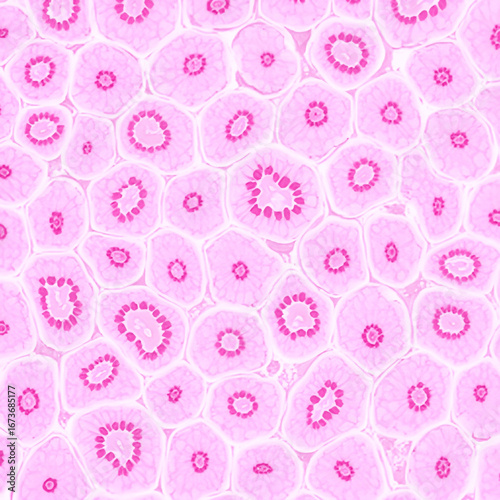 Microscopic image of lobular carcinoma arising in the lobules of the breast, showing the characteristic small