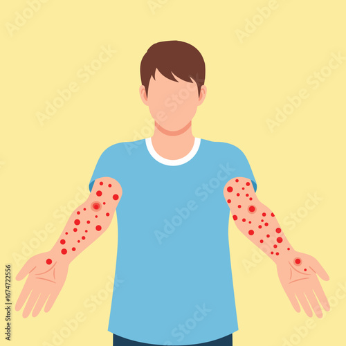 Illustration of Man with Severe Red Rash on Arms Showing Viral Skin Disease Symptoms