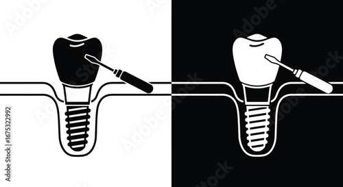 Dental Implant Procedure Illustration in Black and White.