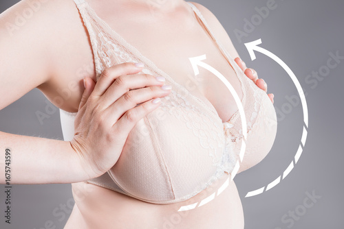 Obraz na plátně Breast augmentation, woman with large saggy breasts after aesthetic lifting proc