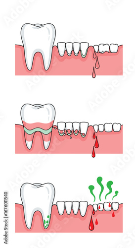 Understanding the stages of gum disease progression and its impact on dental health