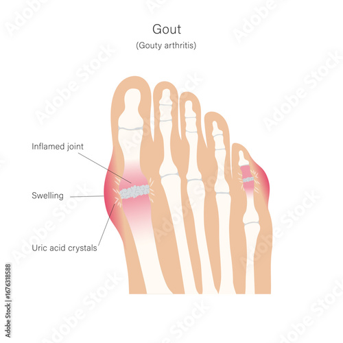 Gout, inflammatory arthritis in foot toes joints, anatomical chart to illustrate pathology of the sickness.