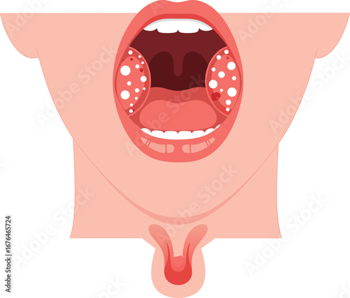 Medical Illustration of Tonsillitis with Inflamed and Swollen Tonsils in Human Throat