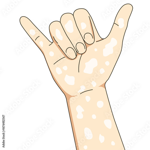Hang loose pose vitiligo people. Unique skin pigmentation highlighting natural beauty. World vitiligo day. Skin depigmentation, skin disorder, self acceptance, emotional support.