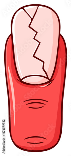 Cartoon illustration of a human finger with a cracked and broken nail, depicting a painful nail injury.
