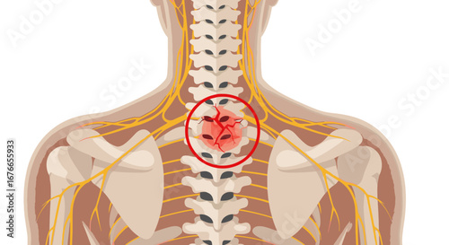 Illustration of Human Spine and Nervous System with Highlighted Pain Area in Upper Back Representing Injury or