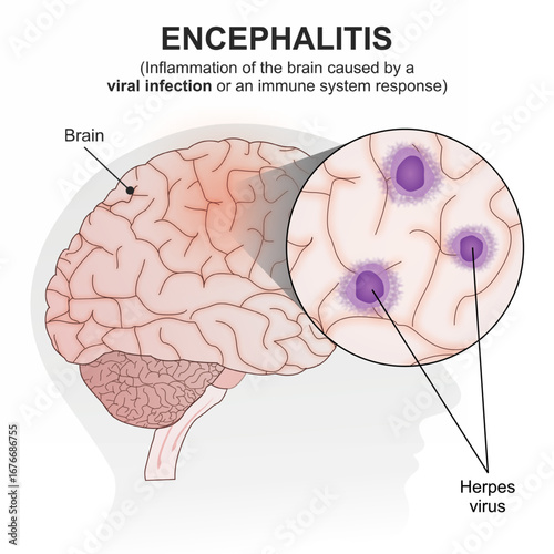 Encephalitis brain viral infection flashcard illustration