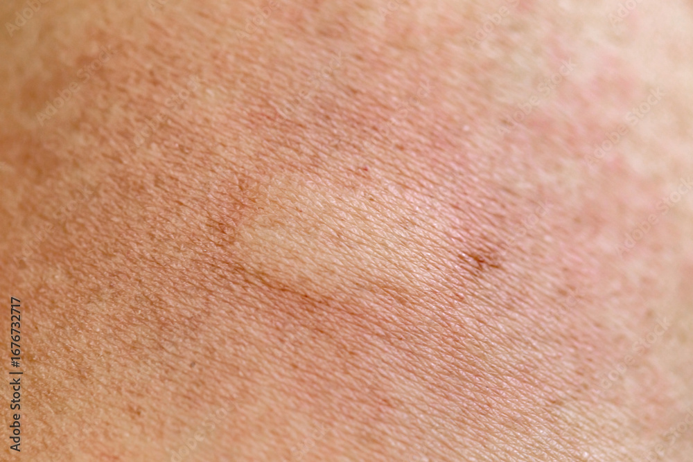 Fototapeta premium Swelling on the skin from insect bites