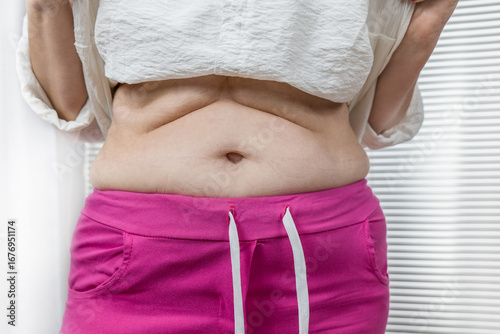 Women with a starting first stage of obesity