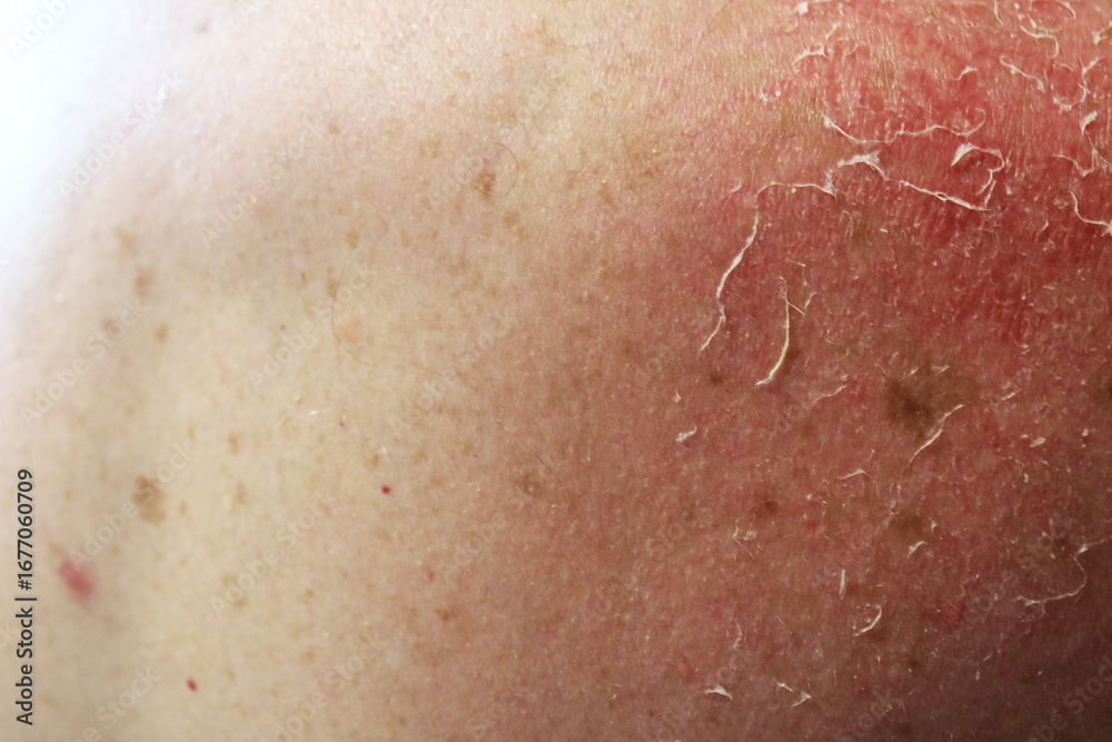 Fototapeta premium The skin peels off after a sunburn. Consequences of sunburn