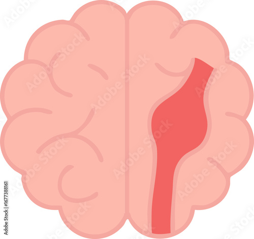 This is a flat vector illustration of a human brain with a highlighted red bulging blood vessel on the right side, representing a brain aneurysm.