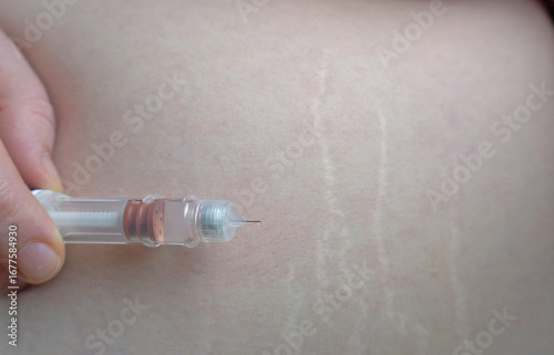 Close-up of a hand holding a weight loss drug near the skin and preparing for subcutaneous injection