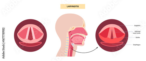 Epiglottitis medical poster