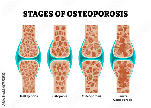 Stages of Osteoporosis bone stages development diagram process for educational medical poster design healthcare scheme, healthy bone, osteopenia, osteoporosis, severe. Skeletal Senior osteopathy