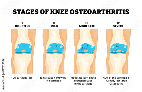 Stages of knee osteoarthritis stages development process diagram for medical poster. Labeled cartilage loss, narrowing joint, moderate joint, osteopathy. Doubtful, Mild, Moderate, Severe Injury.