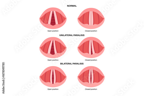 Vocal cords paralysis