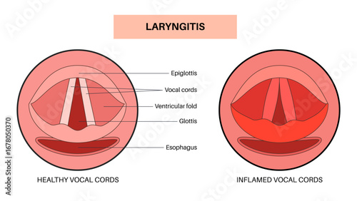 Laryngitis medical poster