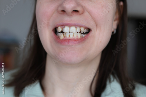 Photography Embracing Imperfections: A Unique Smile