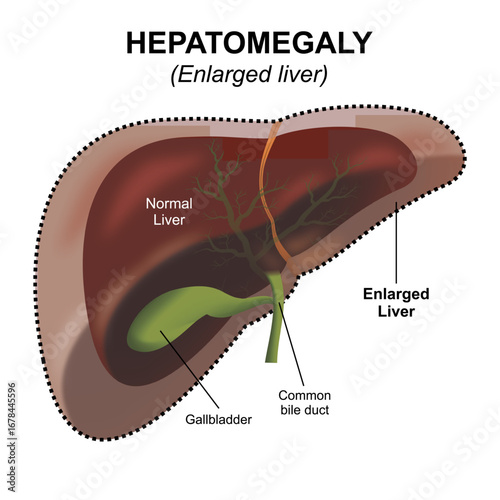Enlarged liver - Hepatomegaly medical liver flashcard illustration
