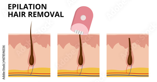 Electric epilator removing hair from underneath skin surface