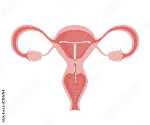 Intrauterine device placed in female uterus, ovaries and fallopian tubes visible