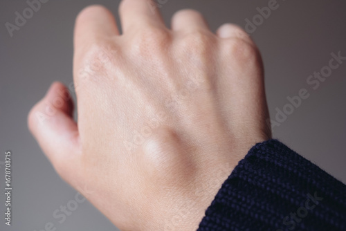 Female right back hand with ganglion cyst on the dorsum,  fluid-filled bump associated with a joint or tendon sheath, close-up view, selected focus.
