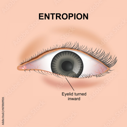 Entropion eye flashcard medical illustration