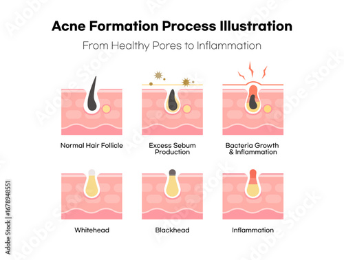 An Illustration of the Acne Formation Process from Healthy Pores to Inflammation.