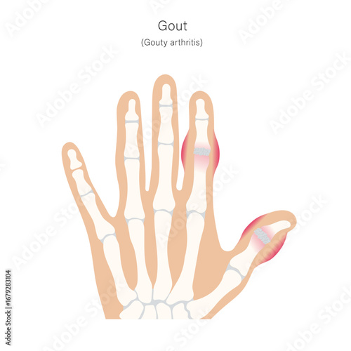 Gout, or inflamatory arthritis of hand fingers.