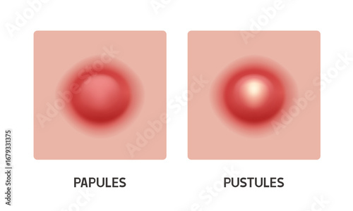 Pustule and papule. Types of acne. Vector 3d illustration