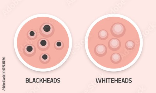 Blackheads and whiteheads. Types of acne. Vector illustration