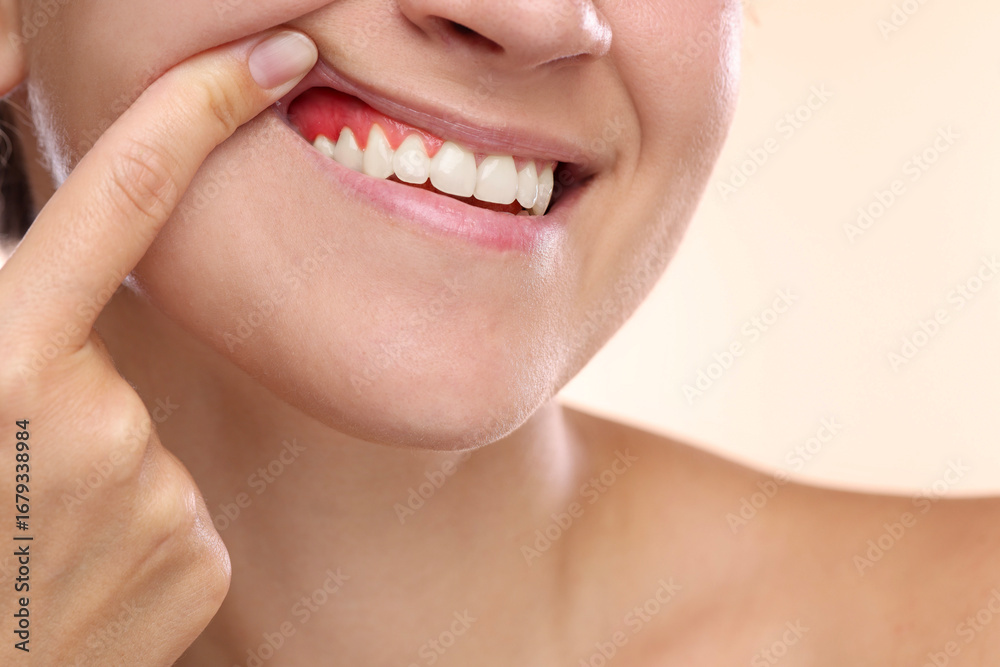 Fototapeta premium Woman showing inflamed gum on beige background, closeup