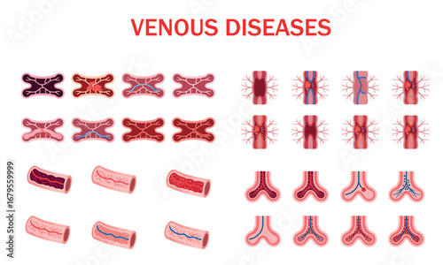 Medical illustration of venous diseases with blood vessel diagram for healthcare and anatomy concept 

